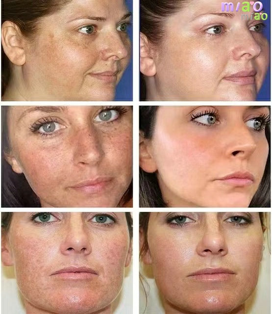 Whitening Freckle Cream Remove Dark Spots Remove Melasma Anti Freckle Cream Fade Pigmentation Skin Anti-Aging Skin Light