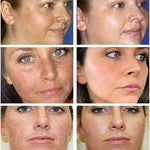 Whitening Freckle Cream Remove Dark Spots Remove Melasma Anti Freckle Cream Fade Pigmentation Skin Anti-Aging Skin Light