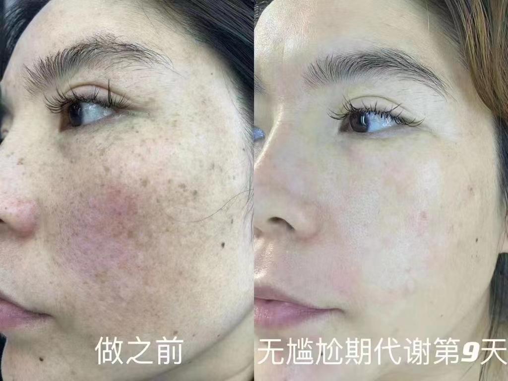 5g freckle treatment